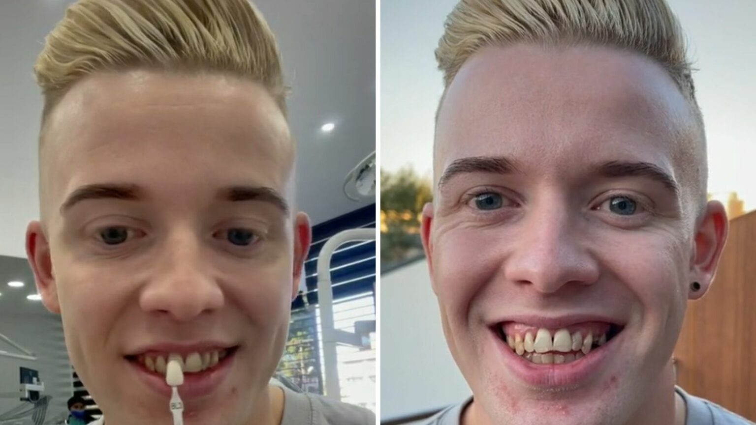 TikToker zrobił sobie tureckie zęby.