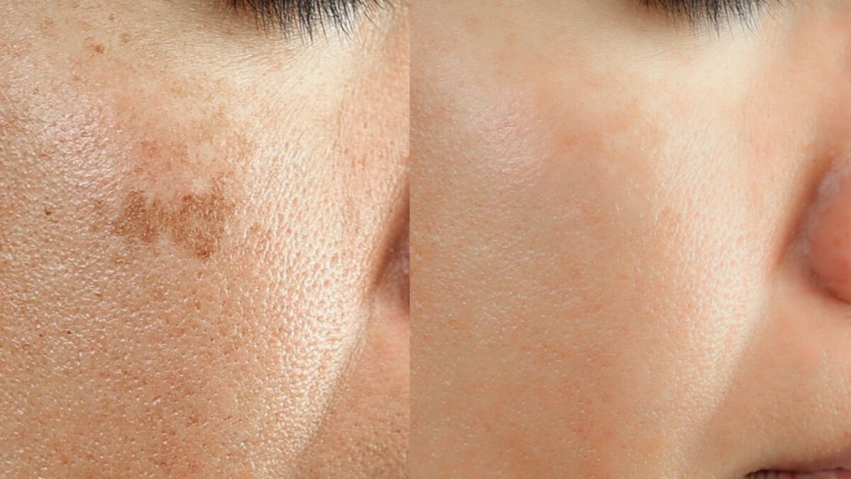 Ciemne plamy pod lupą – jak skutecznie odzyskać jednolity koloryt cery